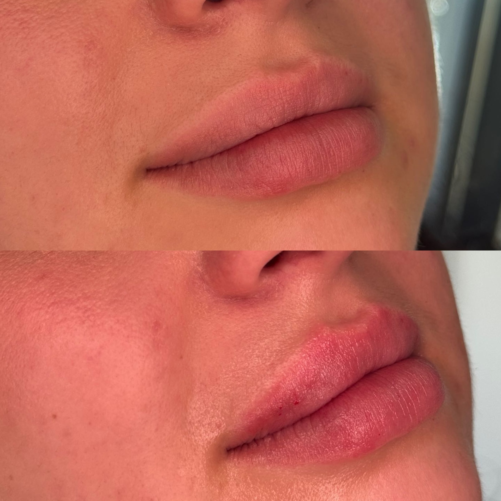 Lip Enhancement result 2