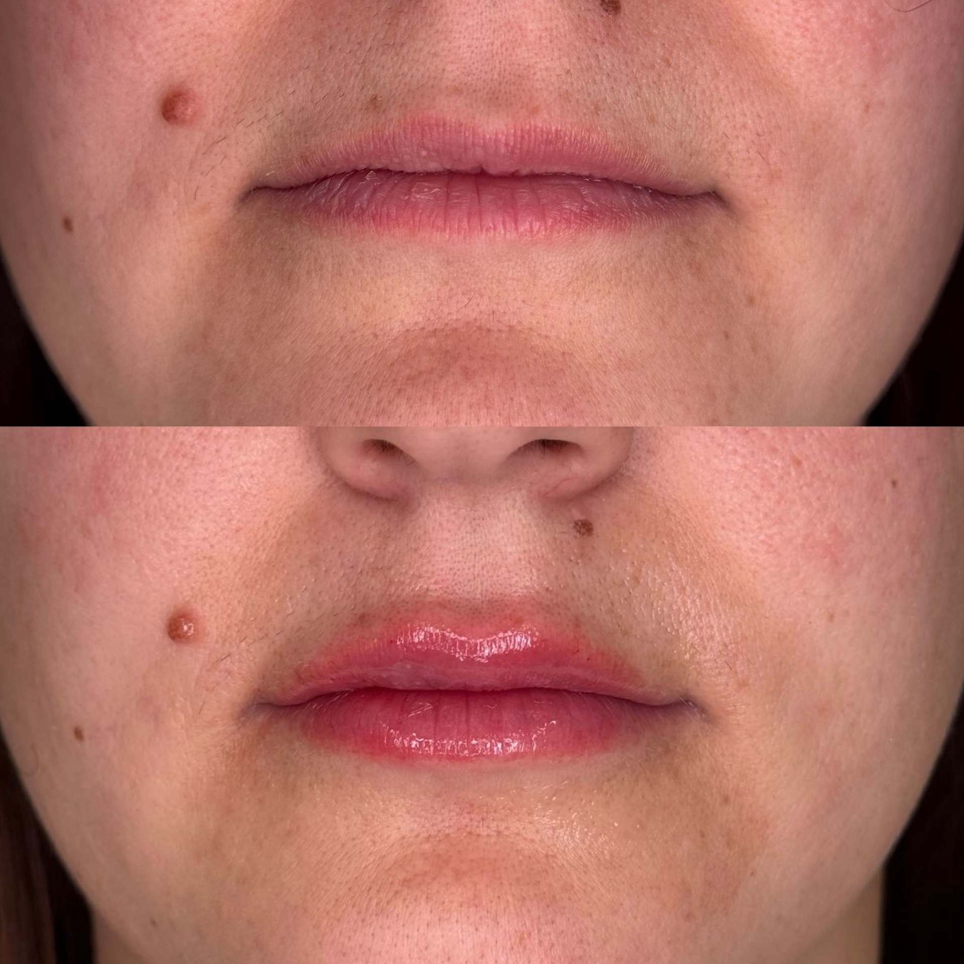 Lip Enhancement result 3