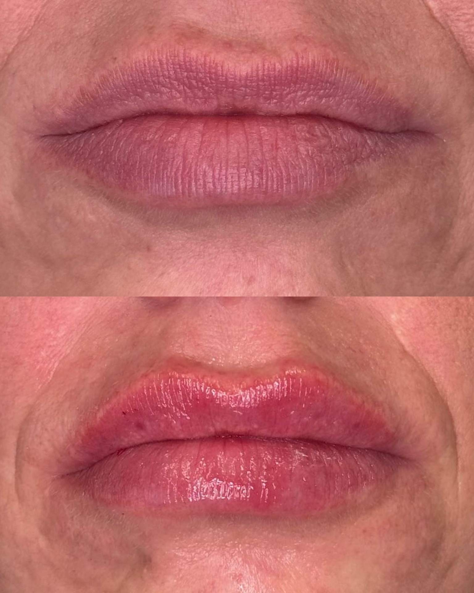 Lip Enhancement result 5
